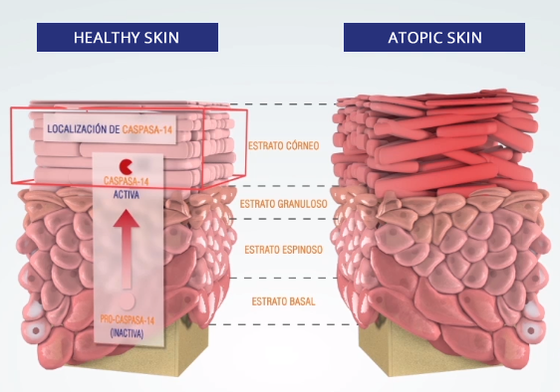 Atopic skin vs healthy skin