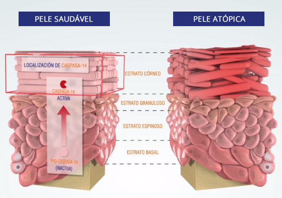 Pele atópica vs pele saludável