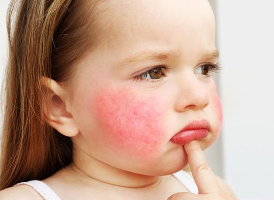 Niña con dermatitis atópica