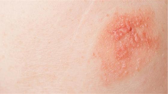 LETI SKIN2 - Piel irritada