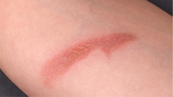 LETI SKIN2 - Agresiones externas