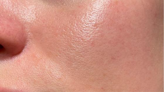 LETI SKIN2 - Post-tratamiento