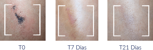 LETI SKIN2 - Mejora en 21 dias