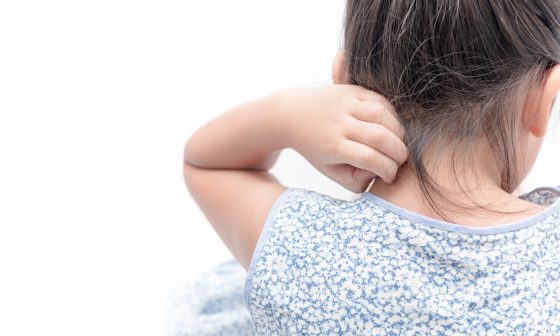 Niño con piel enrojecida debido a dermatitis atópica infantil