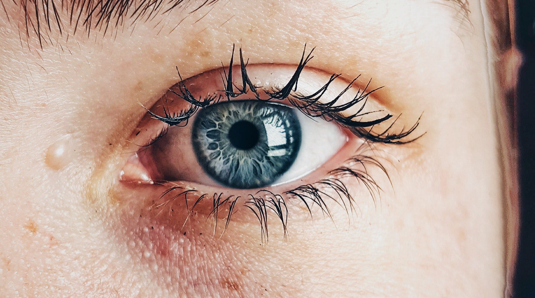 melanoma