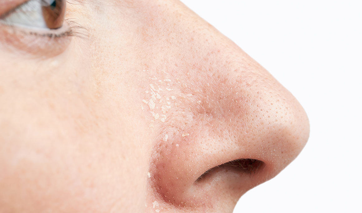 Dermatitis atópica en adultos - tu piel